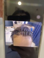 -碧莲盛·不剃发植发