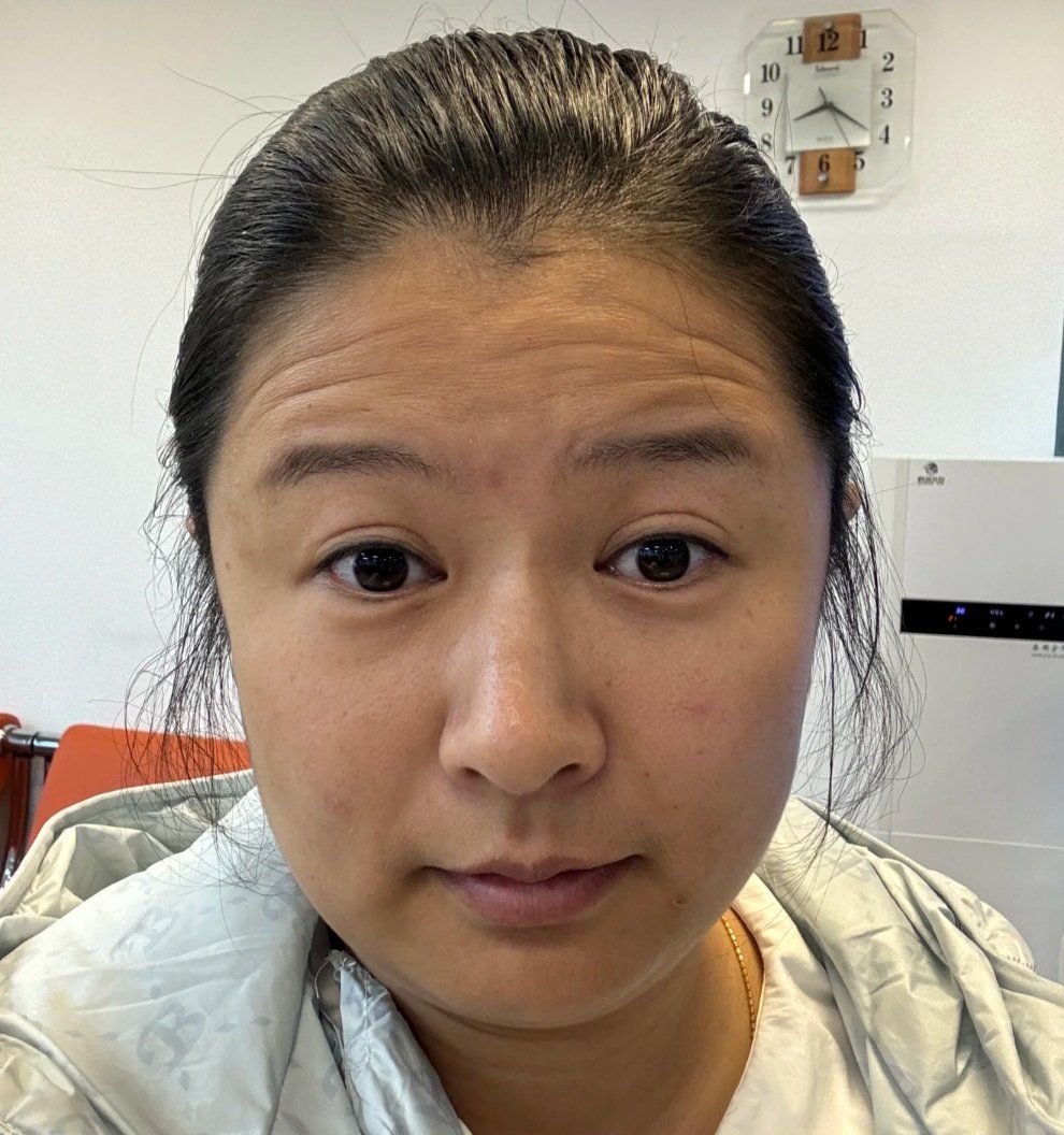 抬头纹"消失"最快的方法