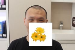 -大麦微针植发丨全国连锁