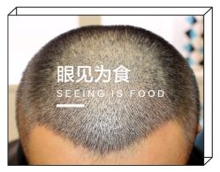 -大麦微针植发全国连锁