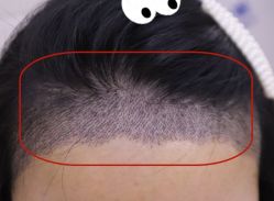 -大麦微针植发全国连锁