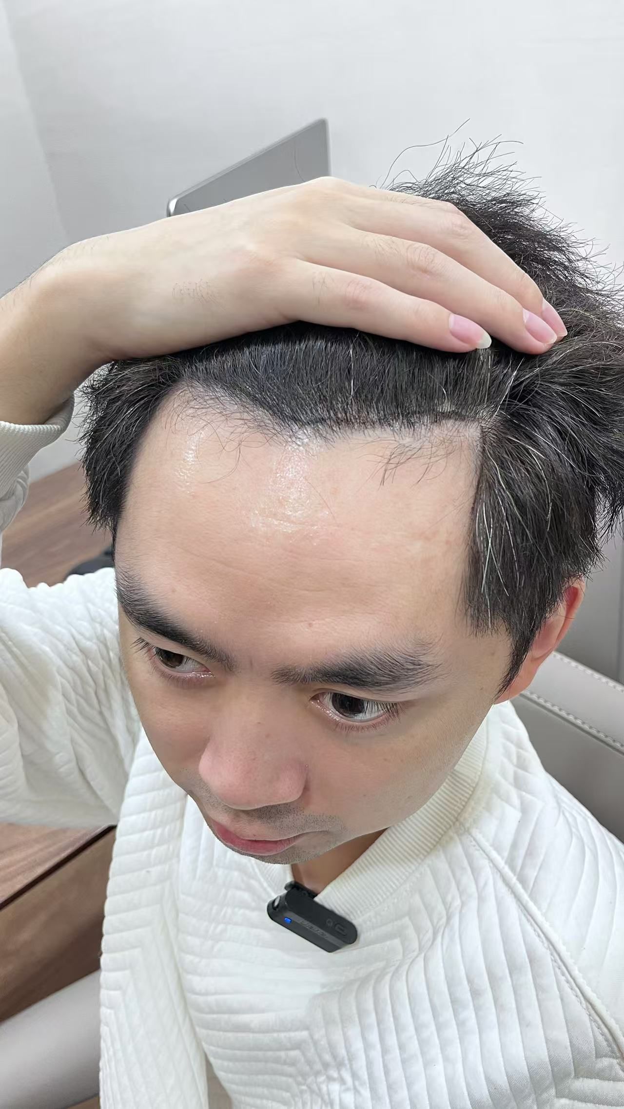 图一真实发际线,图二长头发挡住的样子