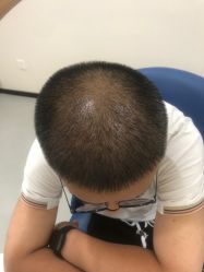 -大麦微针植发全国连锁