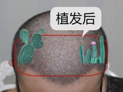 -大麦微针植发全国连锁