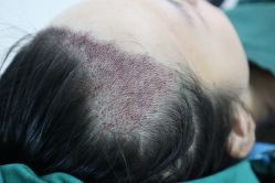 点击看大图 -大麦微针植发丨全国连锁