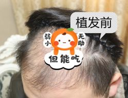 -大麦微针植发全国连锁