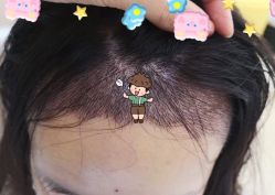 -大麦微针植发全国连锁