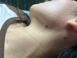 -清疣美疣·痣·斑净肤中心