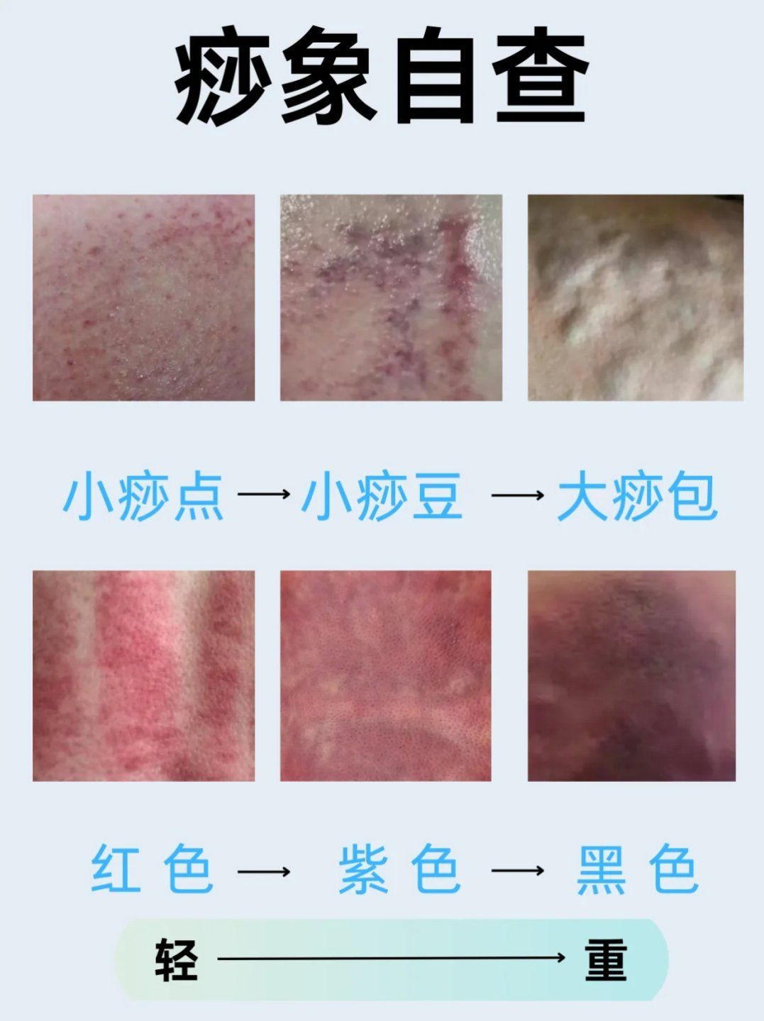刮痧 痧是什么?出痧是什么?痧相
痧是什么?痧是离经之血!