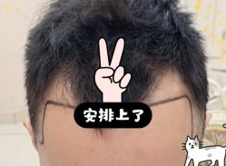 -大麦微针植发全国连锁