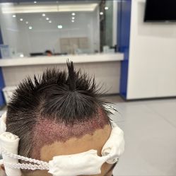 -大麦微针植发全国连锁