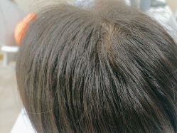 -碧莲盛·不剃发植发