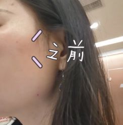 体验前-青岛诺德医学美容医院