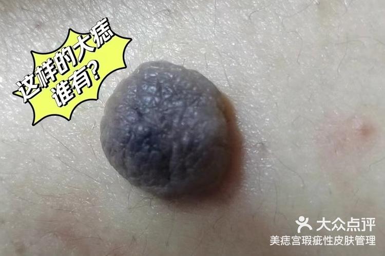 超大肉痣