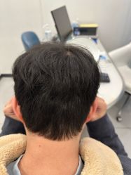 -大麦微针植发全国连锁
