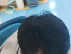 -碧莲盛·不剃发植发