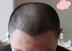 -大麦微针植发丨全国连锁