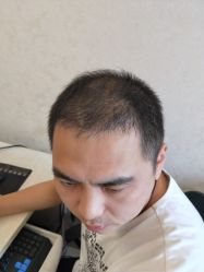 点击看大图 -大麦微针植发丨全国连锁