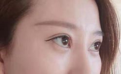 -天津健丽·去眼袋医疗美容机构