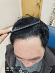 体验后-大麦微针植发丨全国连锁