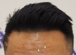 -大麦微针植发全国连锁