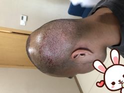 点击看大图 -大麦微针植发丨全国连锁