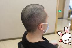 -大麦微针植发丨全国连锁