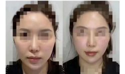 -菊子小颜·日式整骨