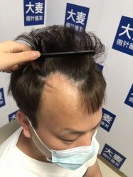 -大麦微针植发丨全国连锁