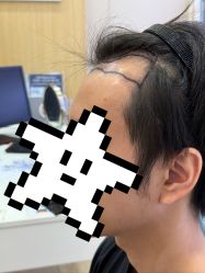 -大麦微针植发全国连锁