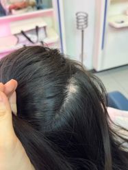 -大麦微针植发全国连锁