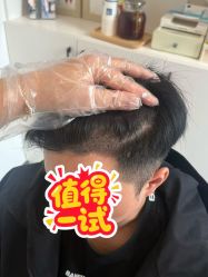 -大麦微针植发全国连锁