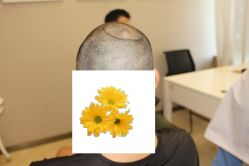 -大麦微针植发丨全国连锁