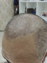 点击看大图 -新生植发·植养护一体
