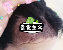 -大麦微针植发全国连锁