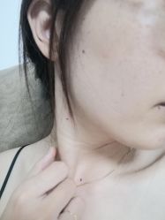 -痣清宫祛斑祛痣连锁店