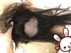 -大麦微针植发丨全国连锁