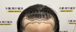 -大麦微针植发全国连锁