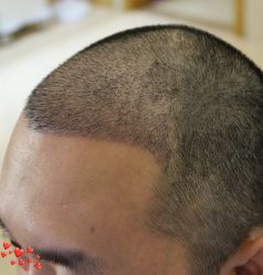 -大麦微针植发丨全国连锁