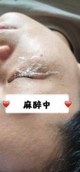 -爱莎扁平疣·汗管瘤·斑痣中心