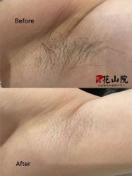 -觅屿日式脱毛美肤