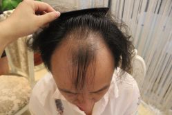 点击看大图 -大麦微针植发丨全国连锁