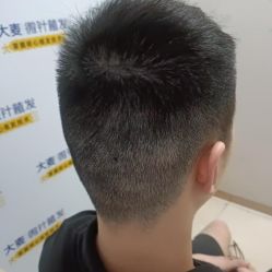-大麦微针植发丨全国连锁
