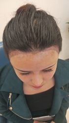 -大麦微针植发丨全国连锁