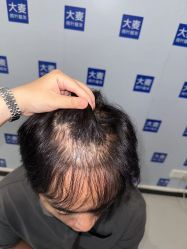 体验前-大麦微针植发丨全国连锁