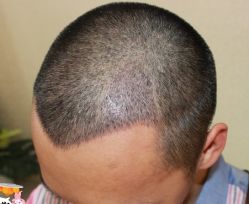 -大麦微针植发丨全国连锁