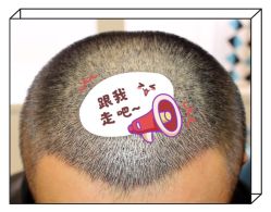 -大麦微针植发全国连锁