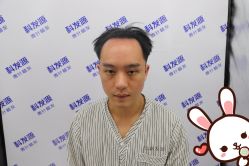 点击看大图 -大麦微针植发丨全国连锁