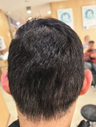 -大麦微针植发丨全国连锁