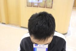 -大麦微针植发丨全国连锁